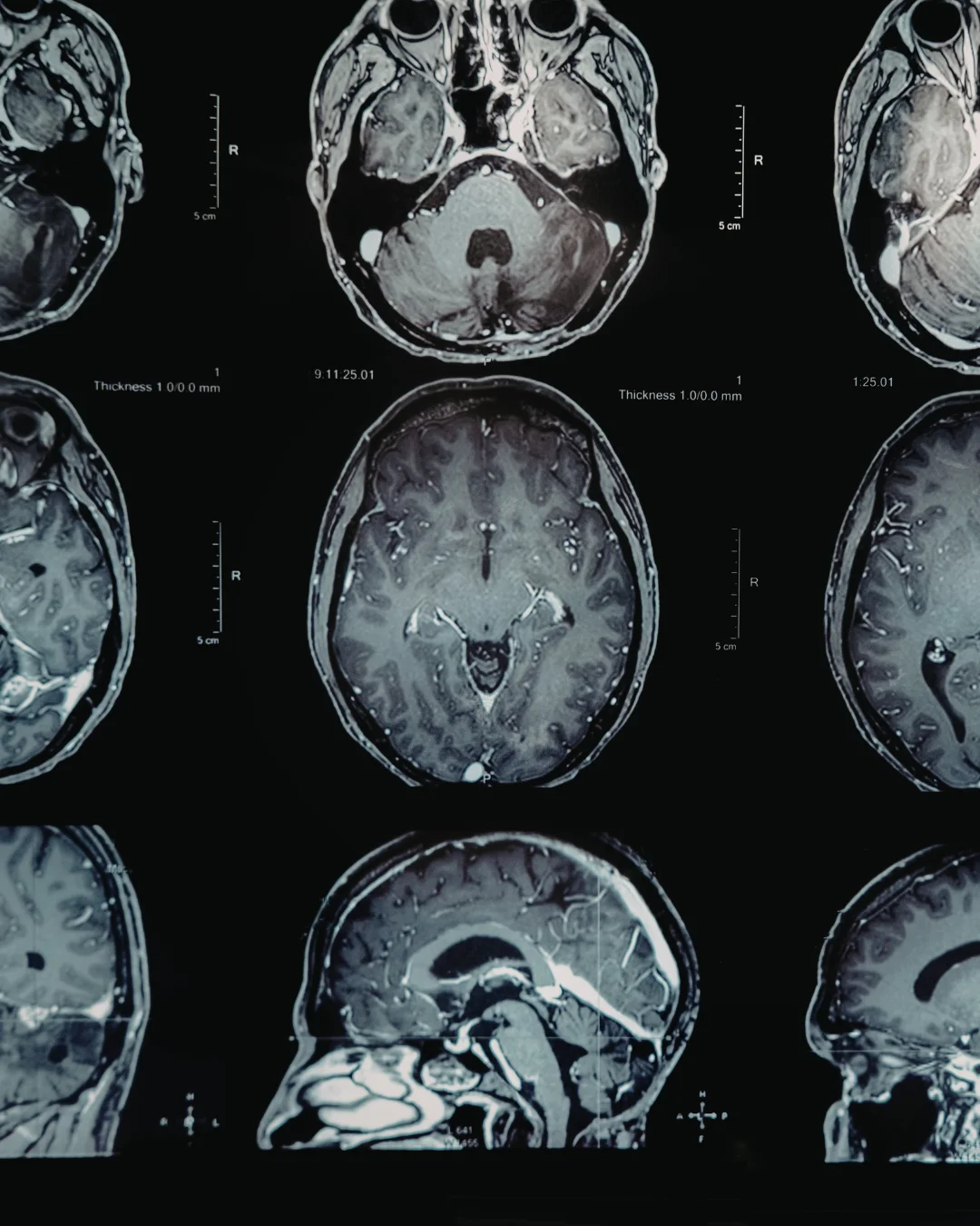 Human brain scan visualization representing cognitive health and longevity research